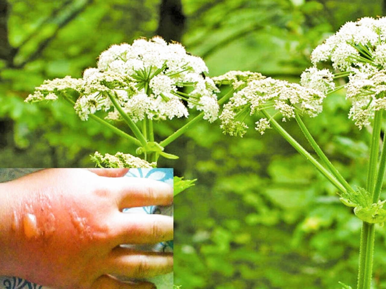 Ожоги от борщевика Сосновского